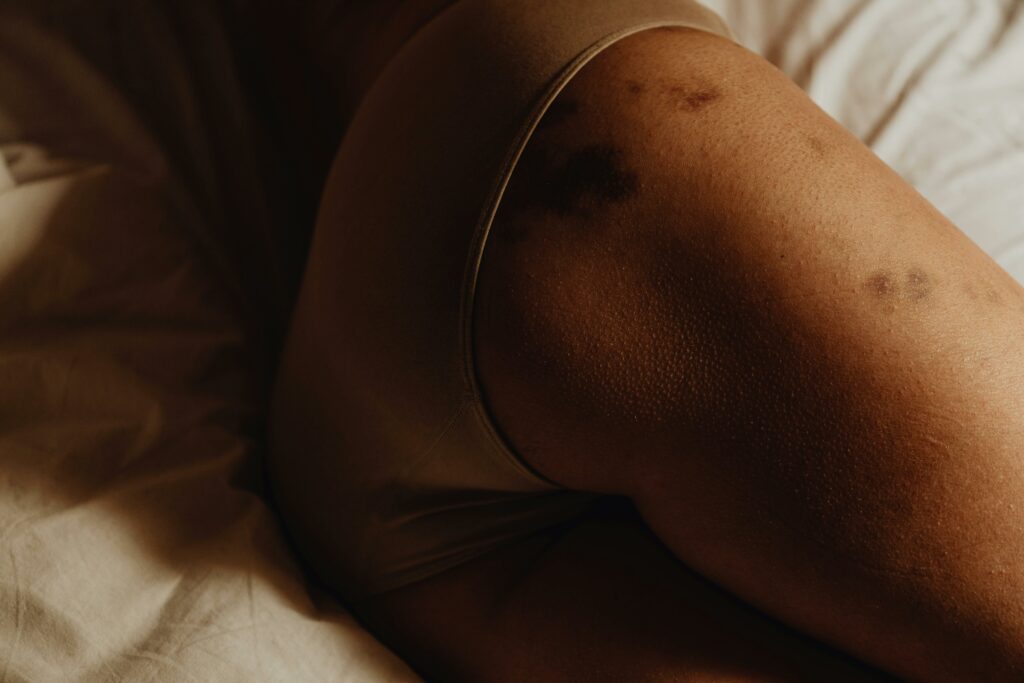 Får du extremt mycket blåmärken? Kan vara Ehlers-Danlos syndrom