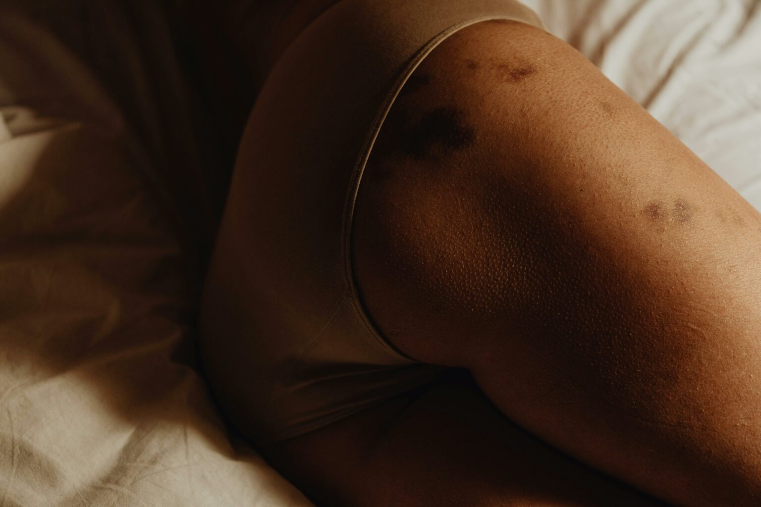 Får du extremt mycket blåmärken? Kan vara Ehlers-Danlos syndrom